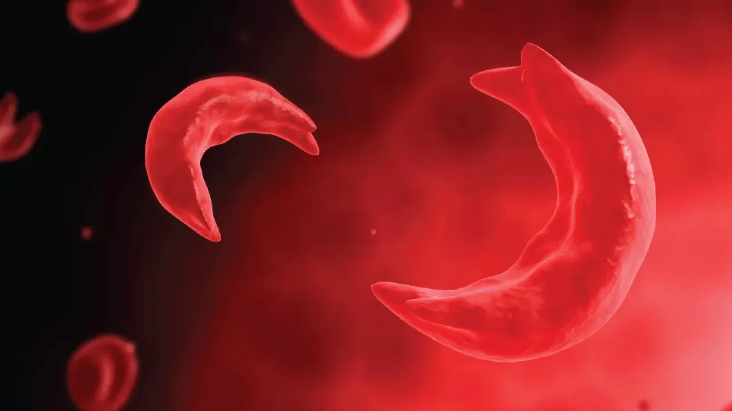 Are the Myths true about Sickle Cell Disorder?